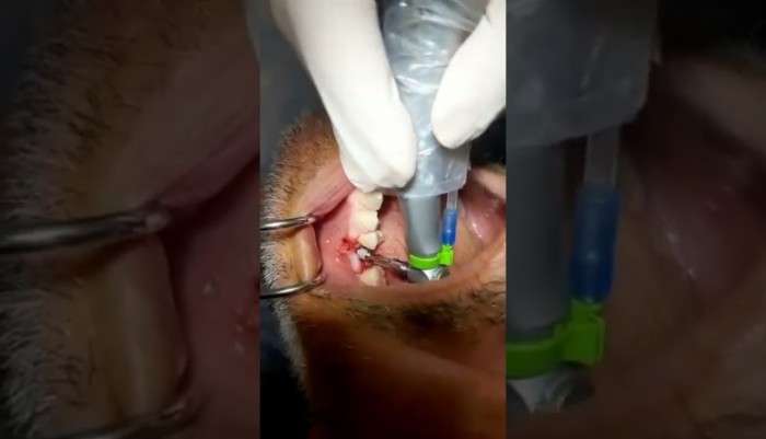 dt-ayten-kocaoglu-implant-operasyonu